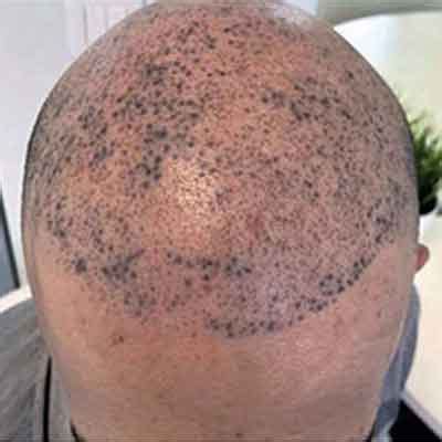 The 5 Biggest Regrets of Scalp Micropigmentation .